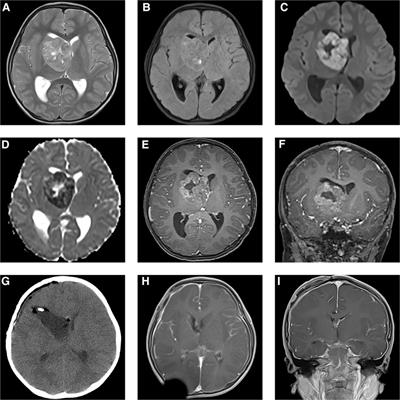 Atypical teratoid/rhabdoid tumour with CDK6 amplification in a child: a case report and literature review